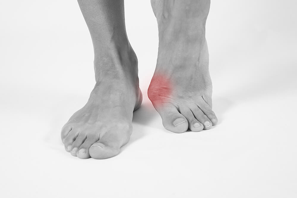 The Common Foot Disorder Bunions My FootDr Singapore