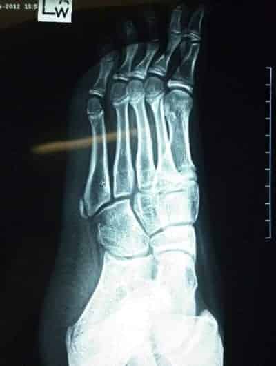 Paediatric Lateral Foot Pains X-ray