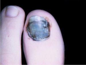 traumatised toenail with bleeding nailbed-001