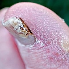 slightly infected toenail