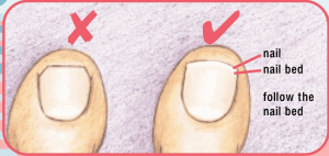 trimming of toenails