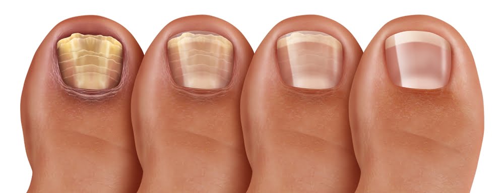 featured image_treatment options for toenail fungus