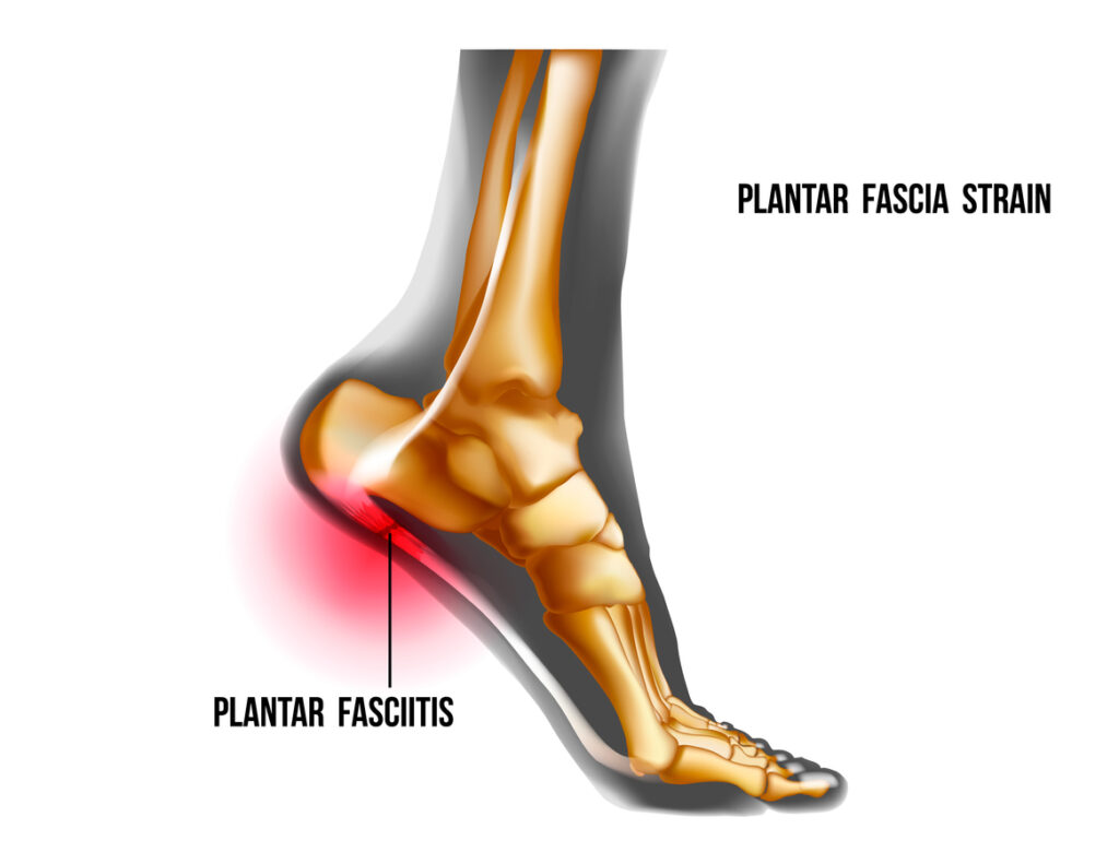 Understanding Plantar Fasciitis Causes, Symptoms & Treatment