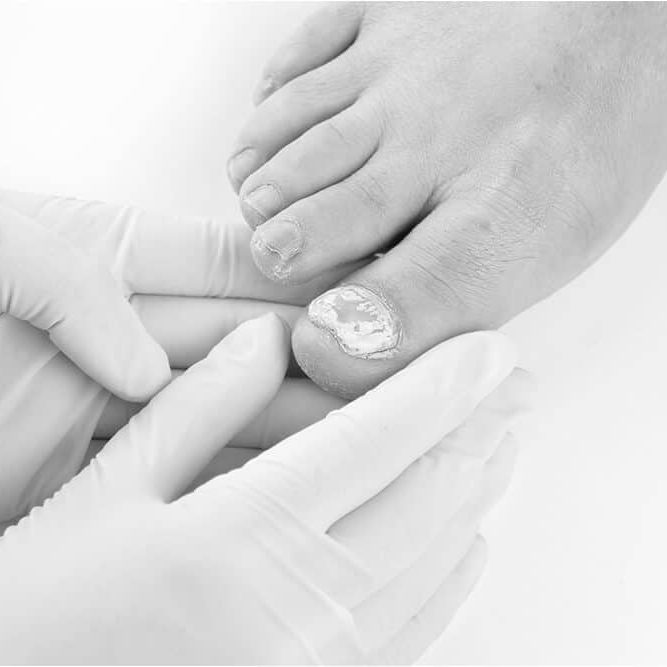 MyFootDr Singapore - Treating Conditions: Fungal Nails Infection